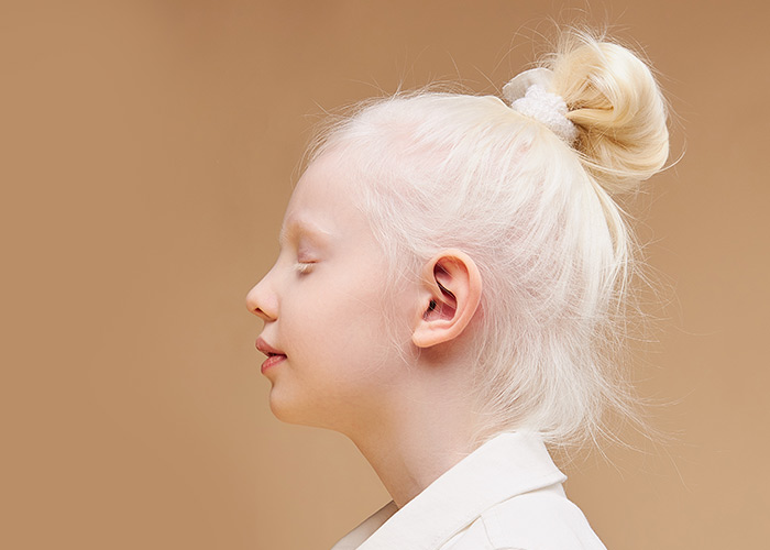 Albinismo requer atenção redobrada