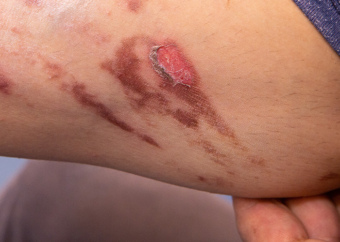 Oxigenoterapia hiperbárica é uma possibilidade de tratamento