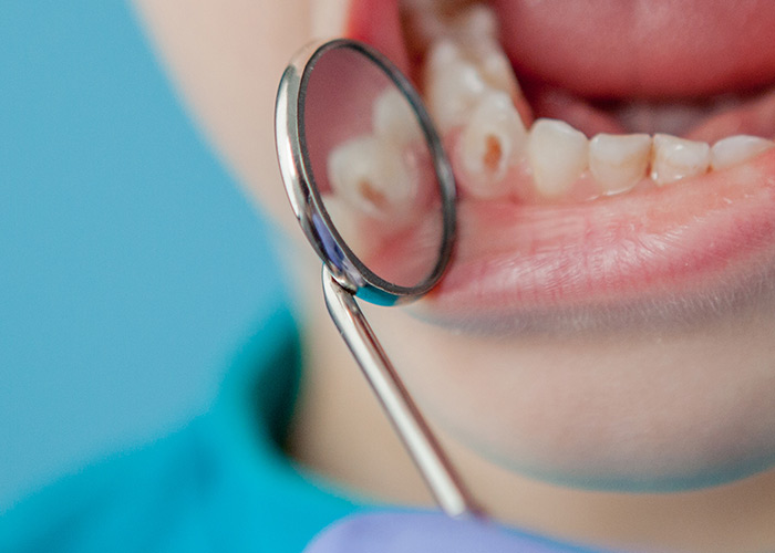 Probiótico e alteração da microbiota oral