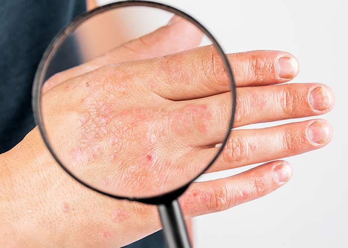 Pele ressecada e sensível