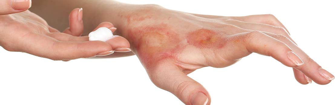 Dia Nacional de Luta Contra Queimaduras