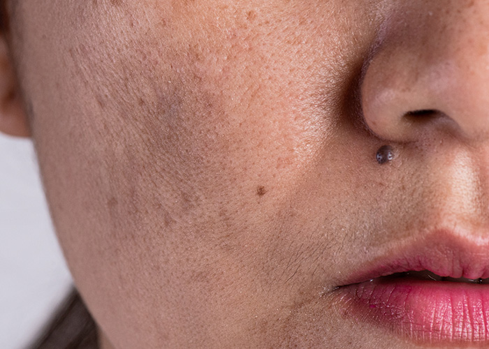 Manchas de melasma