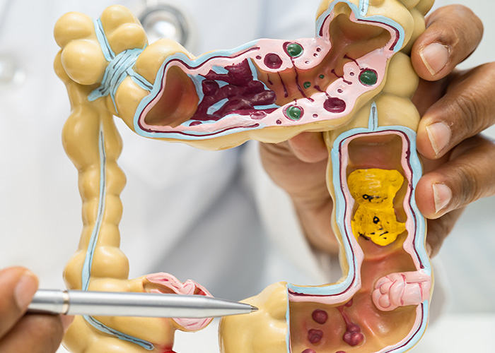 Transplante de microbiota fecal