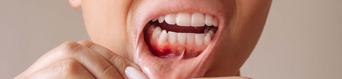 Carcinoma epidermóide oral