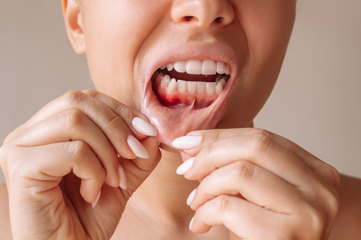 Carcinoma epidermóide oral