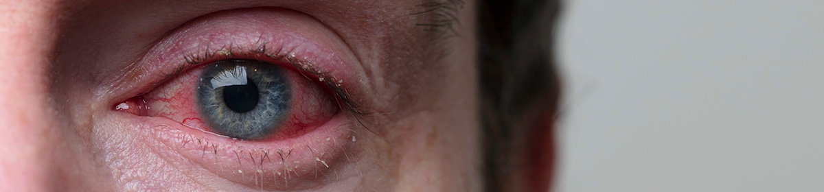 Herpes ocular