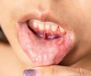 Infecção sexualmente transmissível