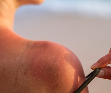 Fotoproteção da pele