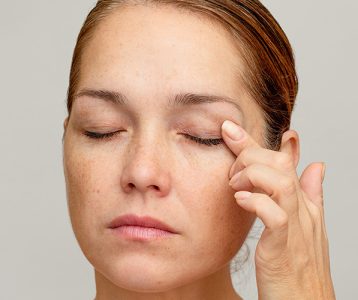 Excesso de pele das pálpebras