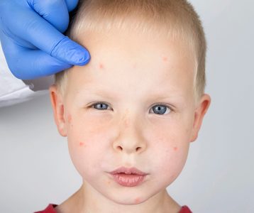 Alergia alimentar na infância