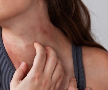 Alergia alimentar