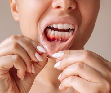 Carcinoma epidermóide oral