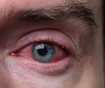 Herpes ocular