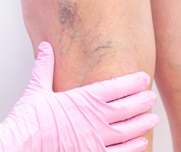 Com os avanços da medicina vascular ocorreu uma verdadeira revolução no tratamento de varizes, com soluções eficazes