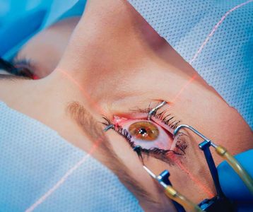 Implante de microlente intraocular
