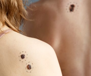 Terapia fotodinâmica no câncer de pele